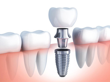 Especilaidades Zamora Dental. Implantes. Clínica dental Almería